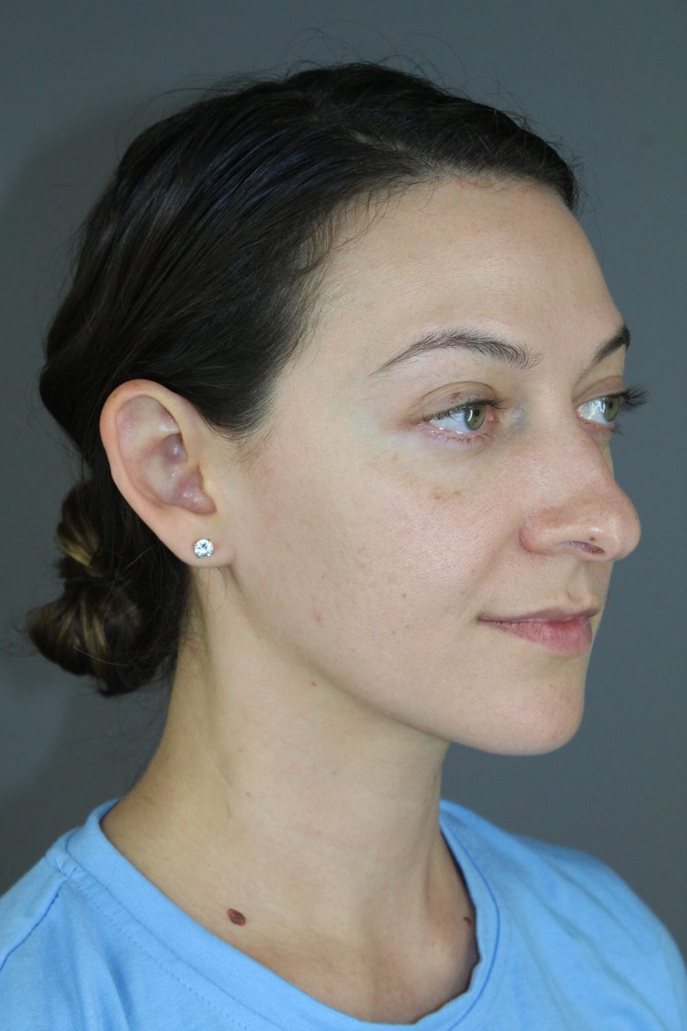 Rhinoplasty Before & After