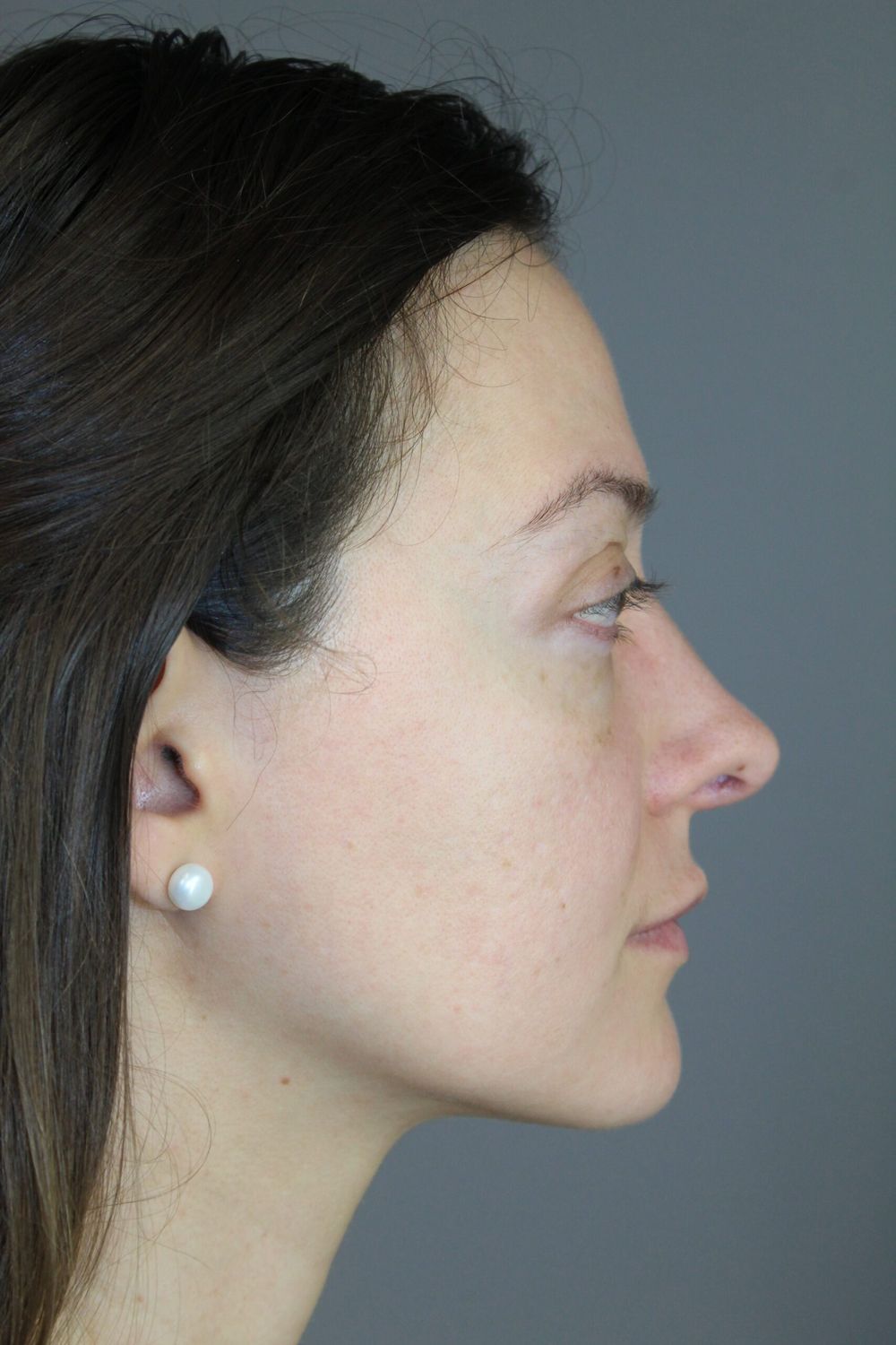 Rhinoplasty Before & After
