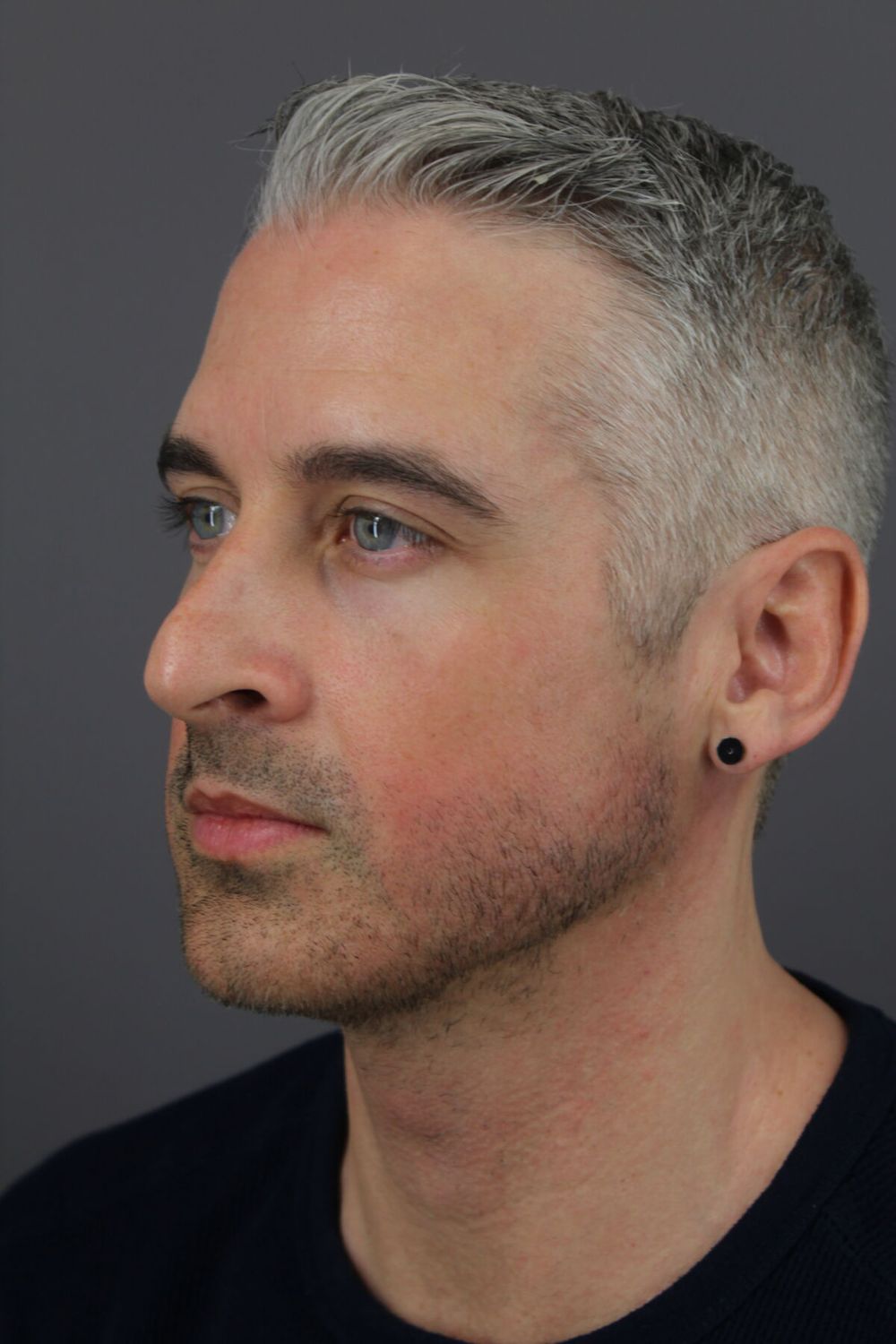 Rhinoplasty Before & After