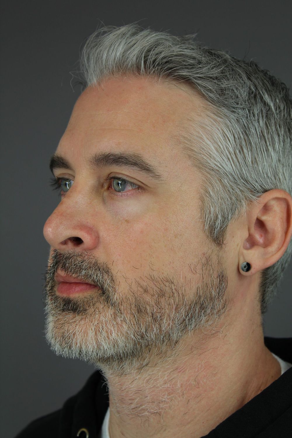 Rhinoplasty Before & After