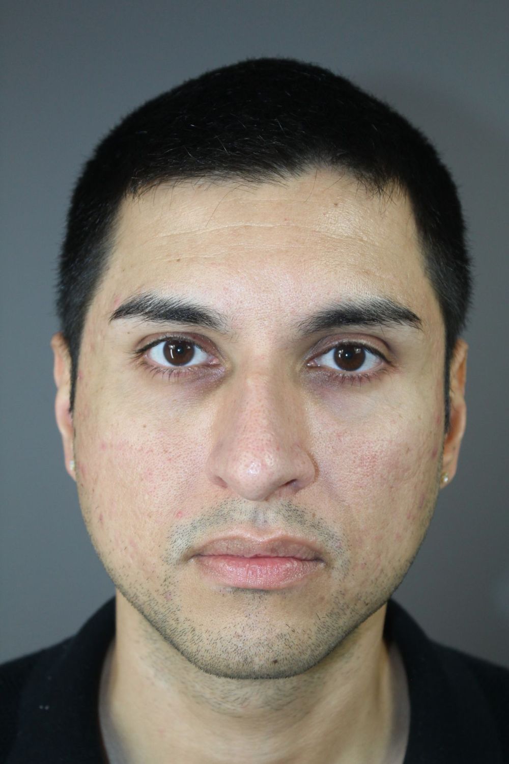 Rhinoplasty Before & After