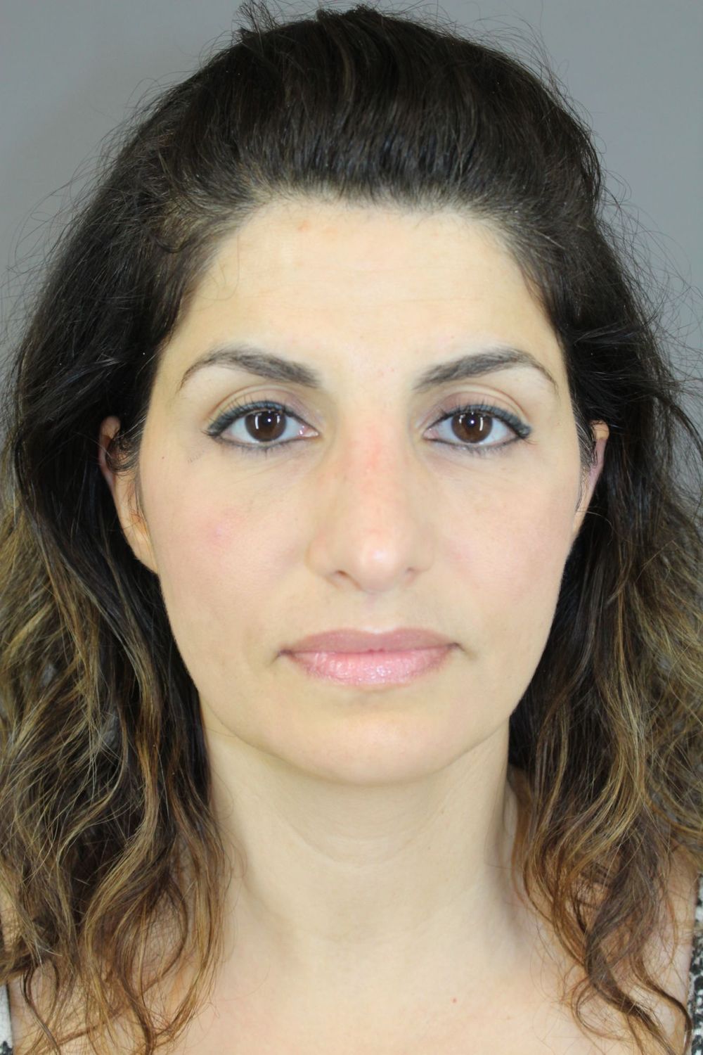 Rhinoplasty Before & After