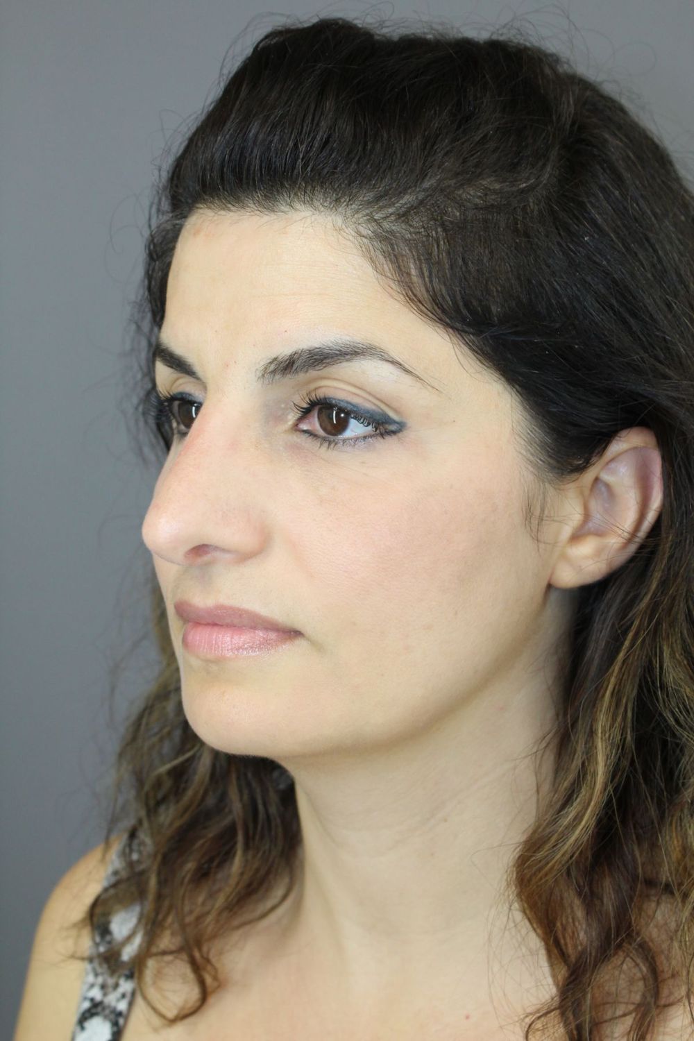 Rhinoplasty Before & After