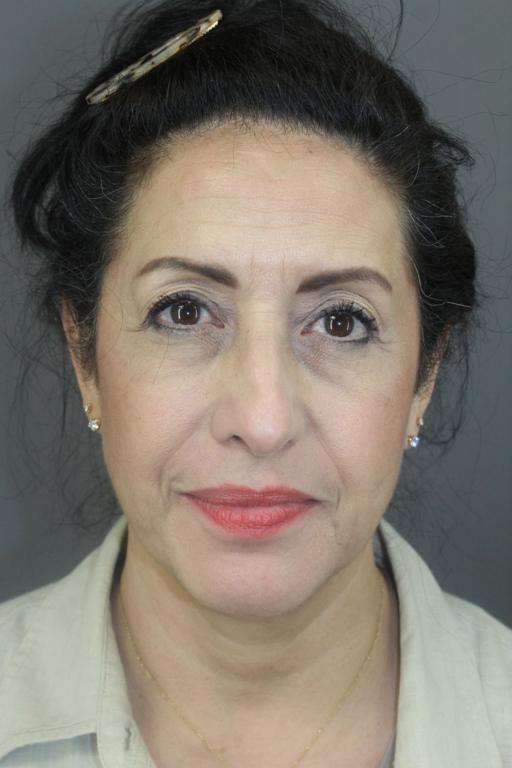 Rhinoplasty Before & After