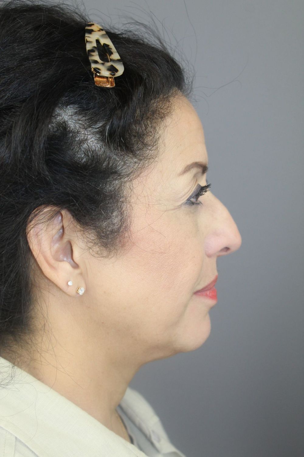 Rhinoplasty Before & After