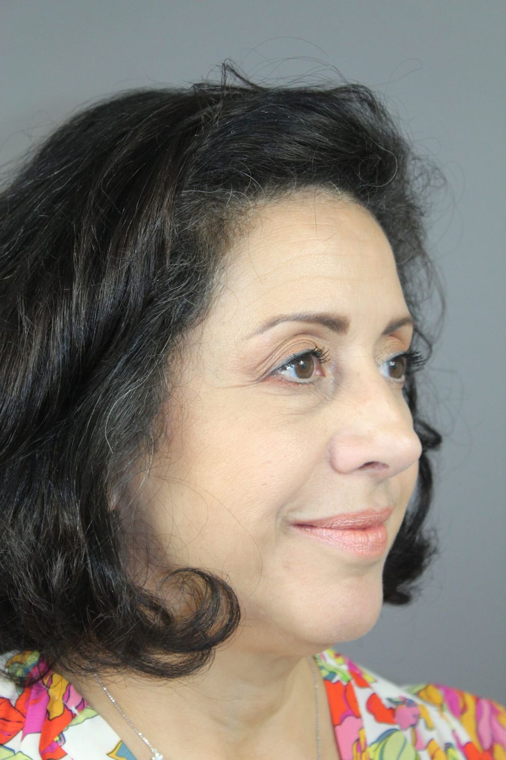 Rhinoplasty Before & After