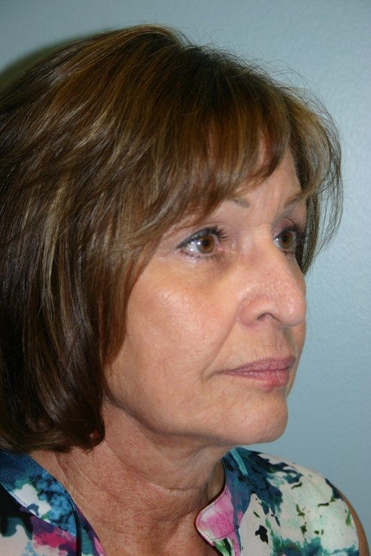 Rhinoplasty Before & After