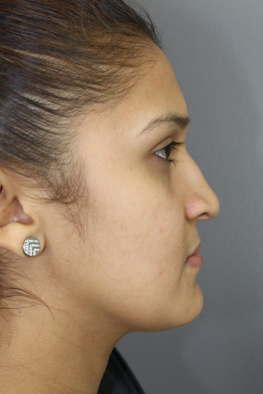 Rhinoplasty Before & After