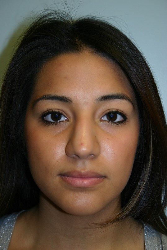 Rhinoplasty Before & After
