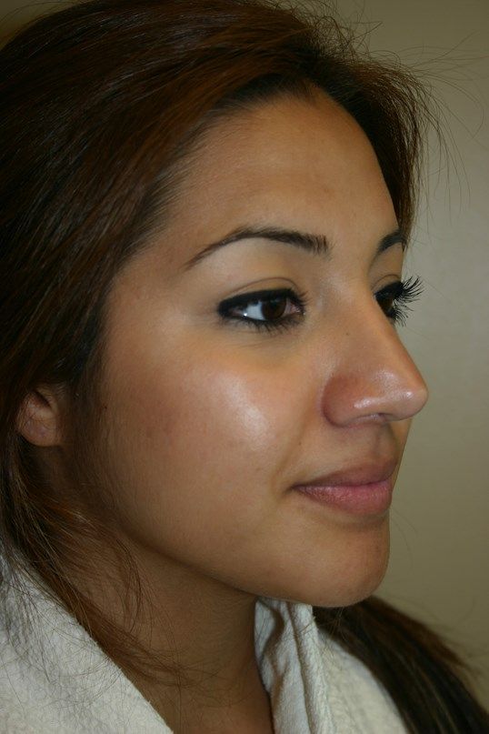 Rhinoplasty Before & After