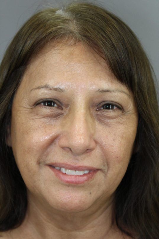 Rhinoplasty Before & After