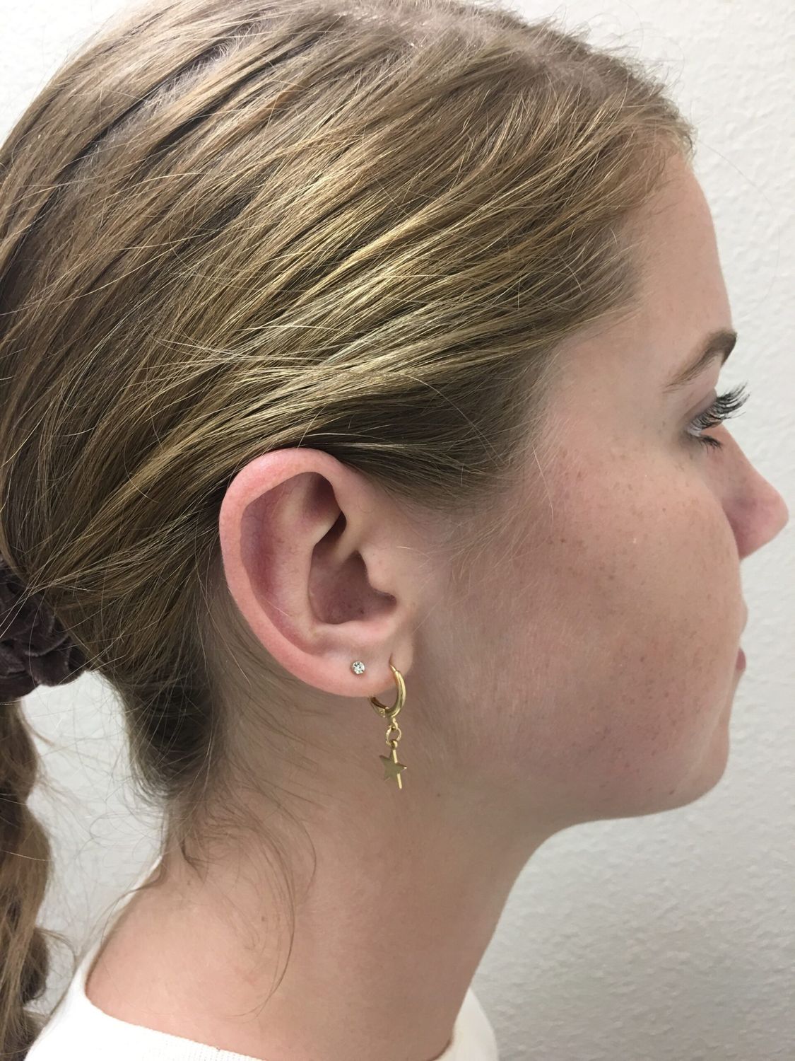 Ear Surgery Before & After