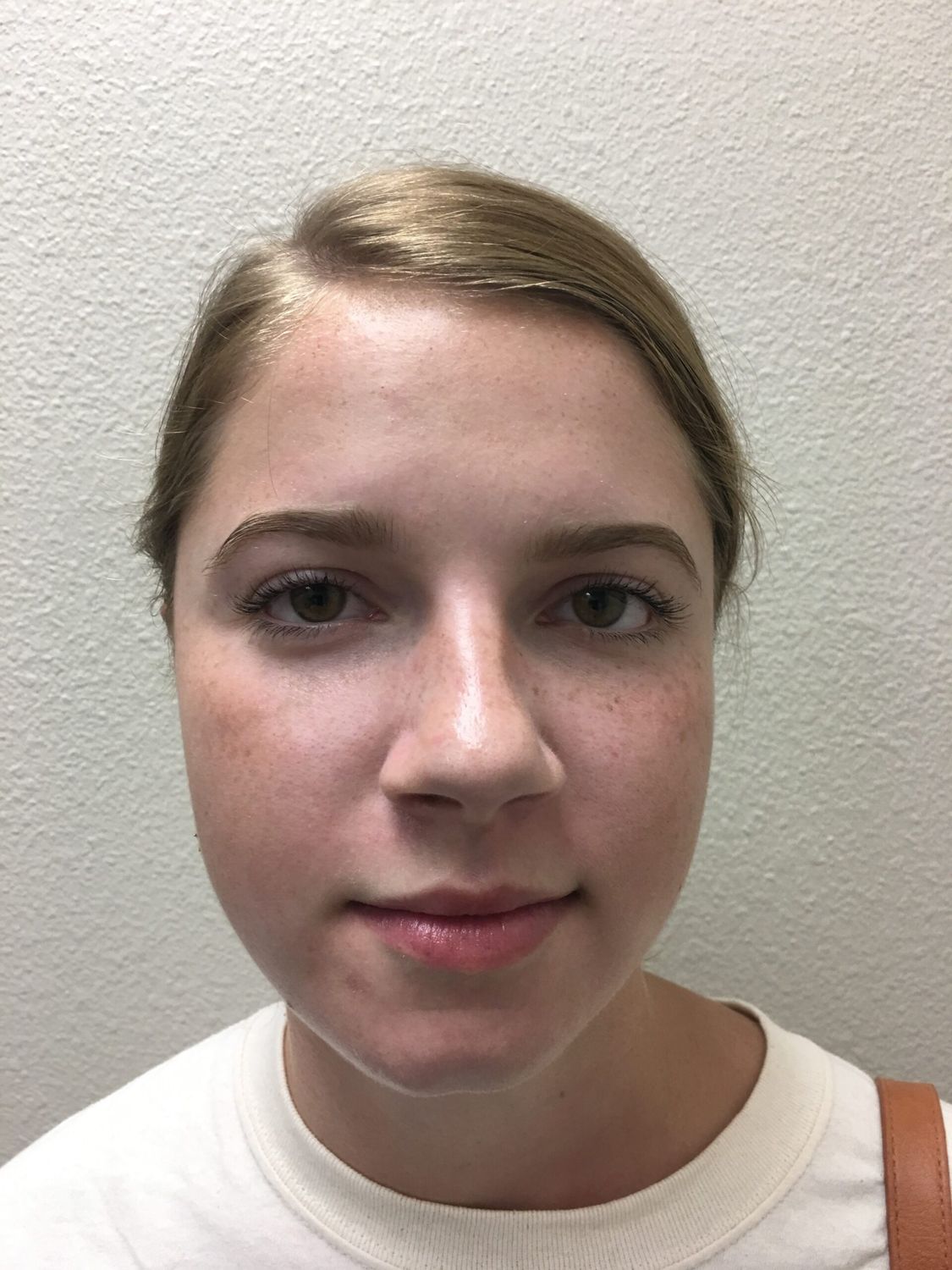 Ear Surgery Before & After