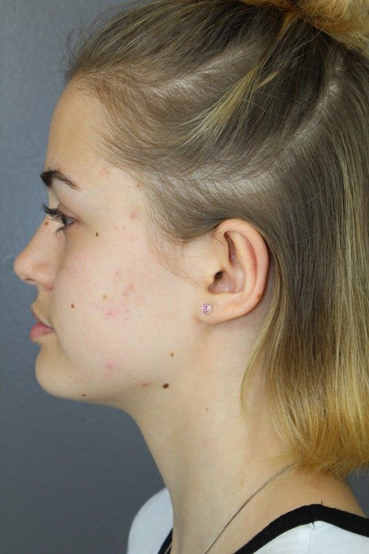 Ear Surgery Before & After