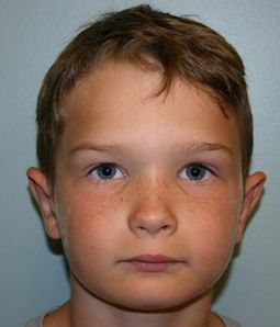 Ear Surgery Before & After