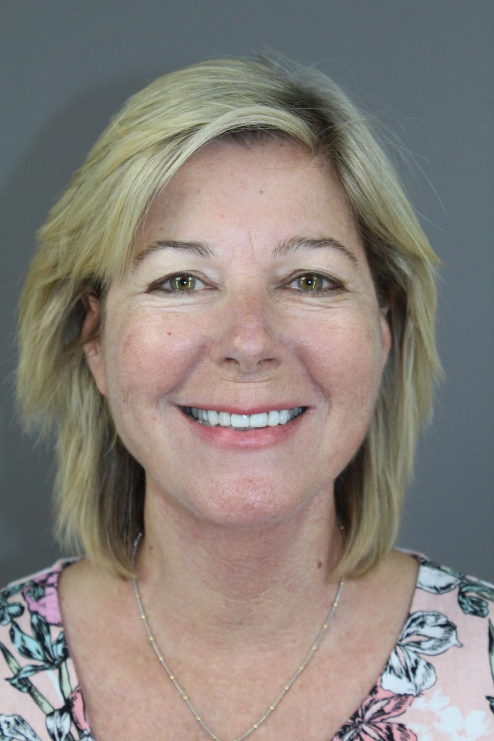 Face Lift Before & After