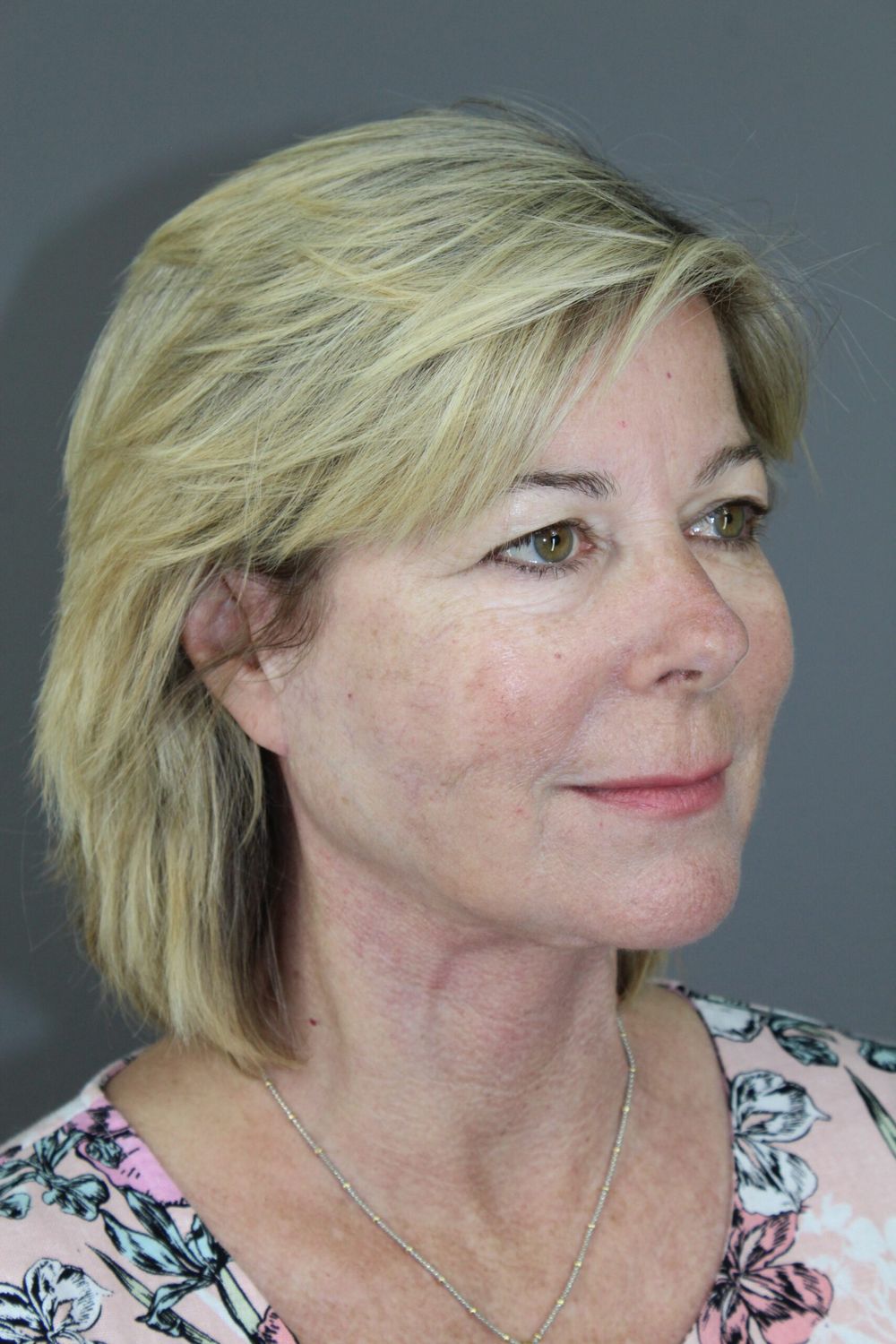 Face Lift Before & After