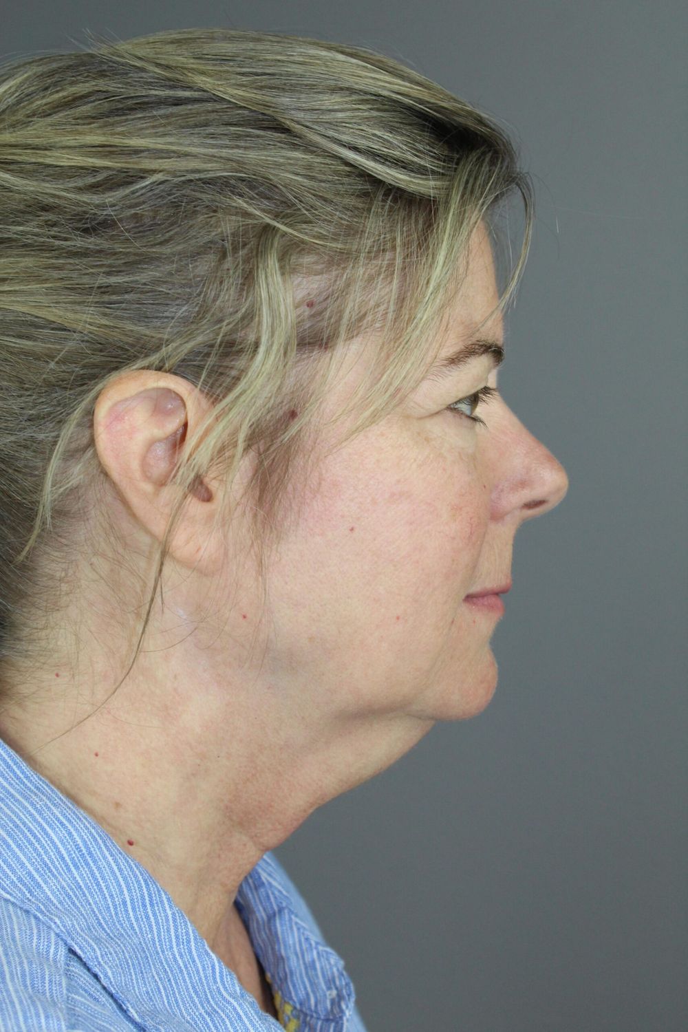 Face Lift Before & After