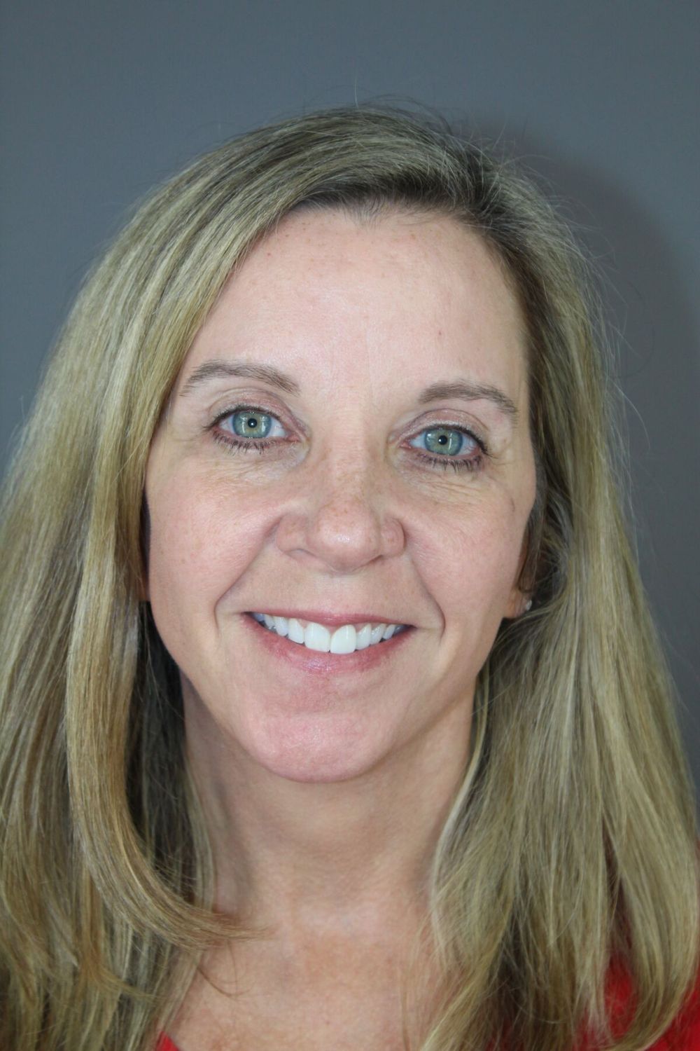 Face Lift Before & After