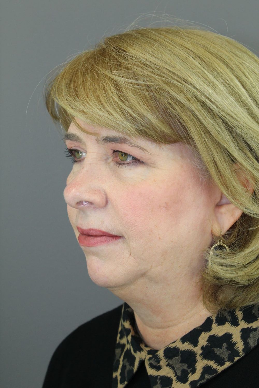 Face Lift Before & After