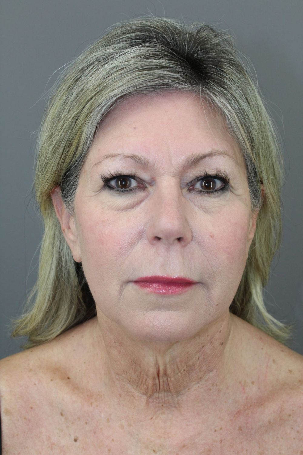 Face Lift Before & After