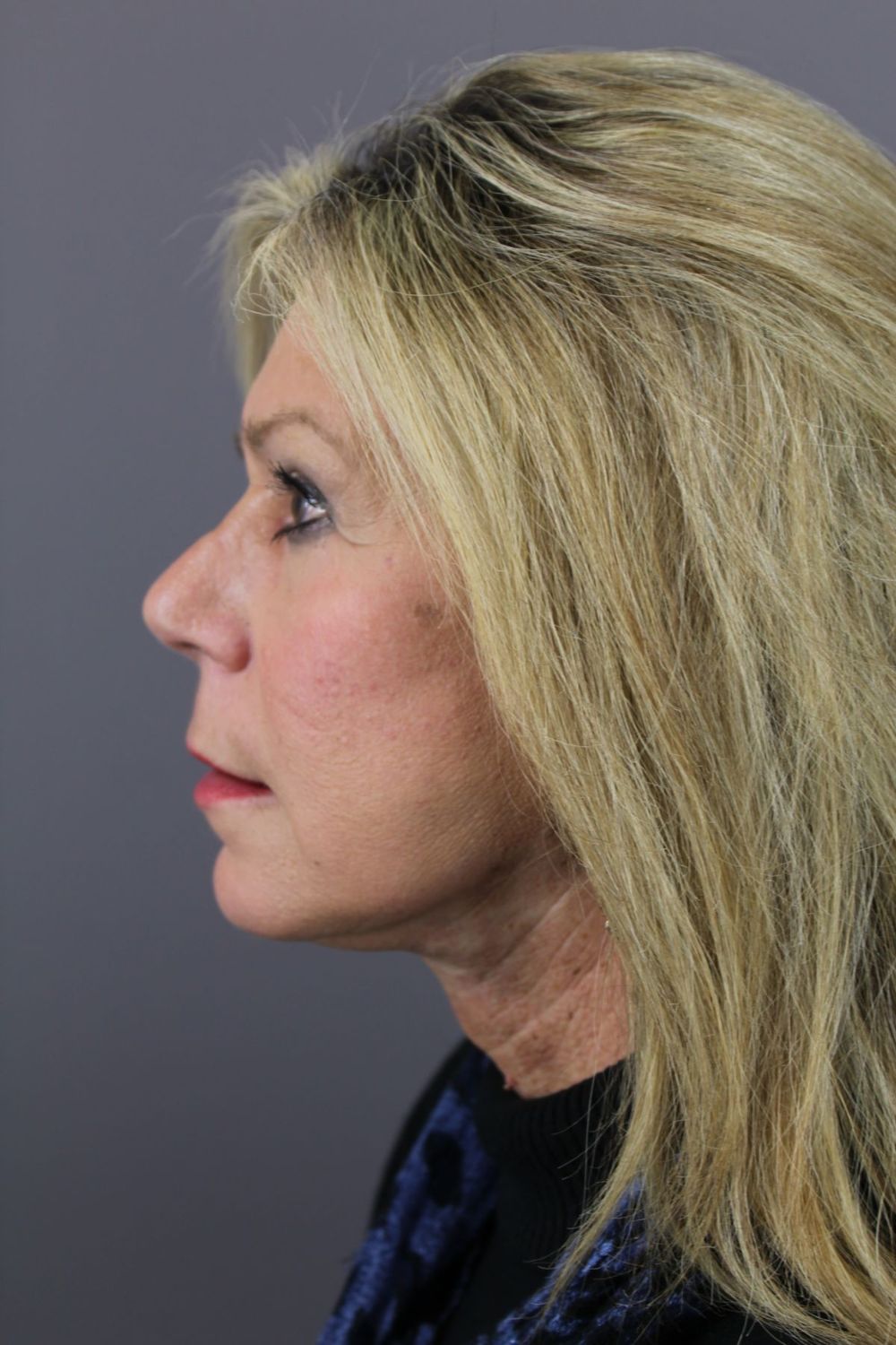 Face Lift Before & After