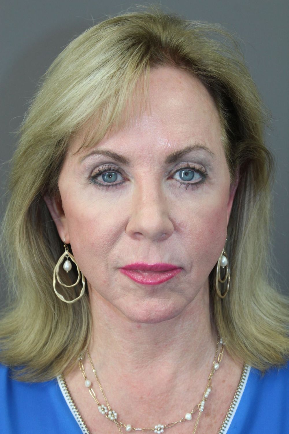 Zo Skin Health Before & After