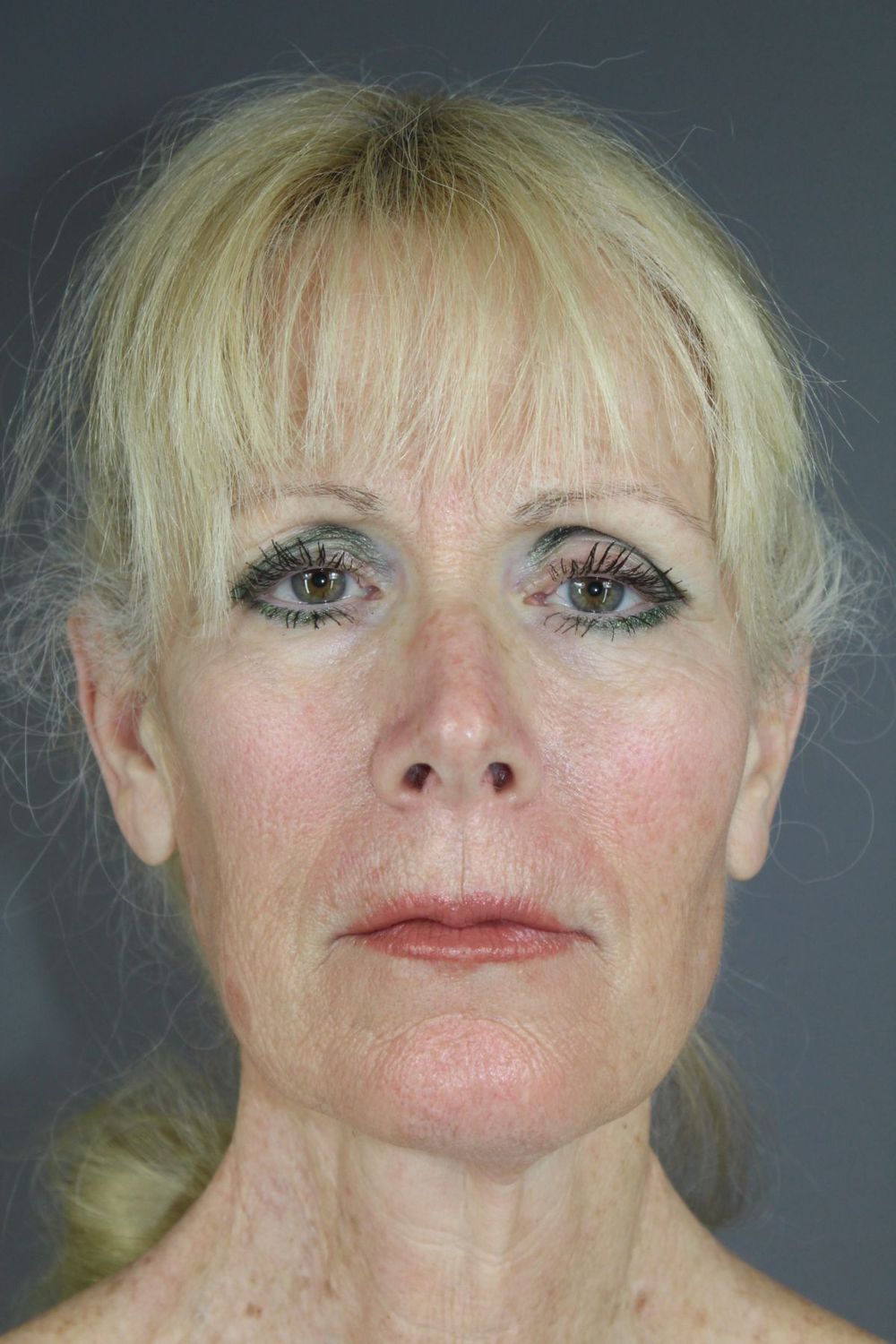 Zo Skin Health Before & After