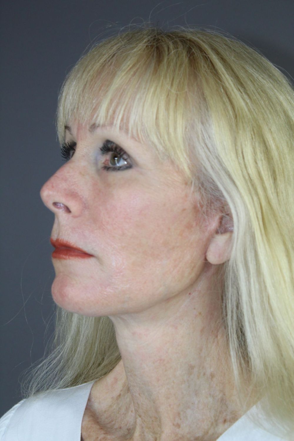 Zo Skin Health Before & After