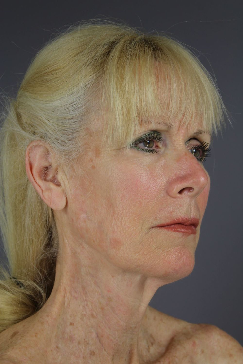 Zo Skin Health Before & After