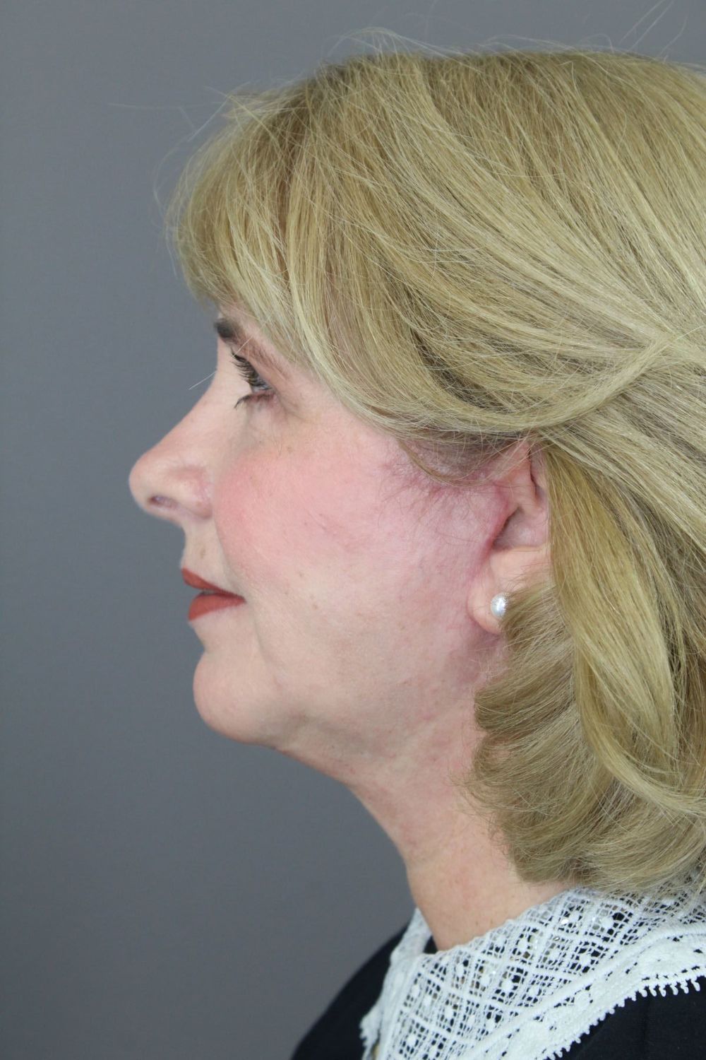 Zo Skin Health Before & After