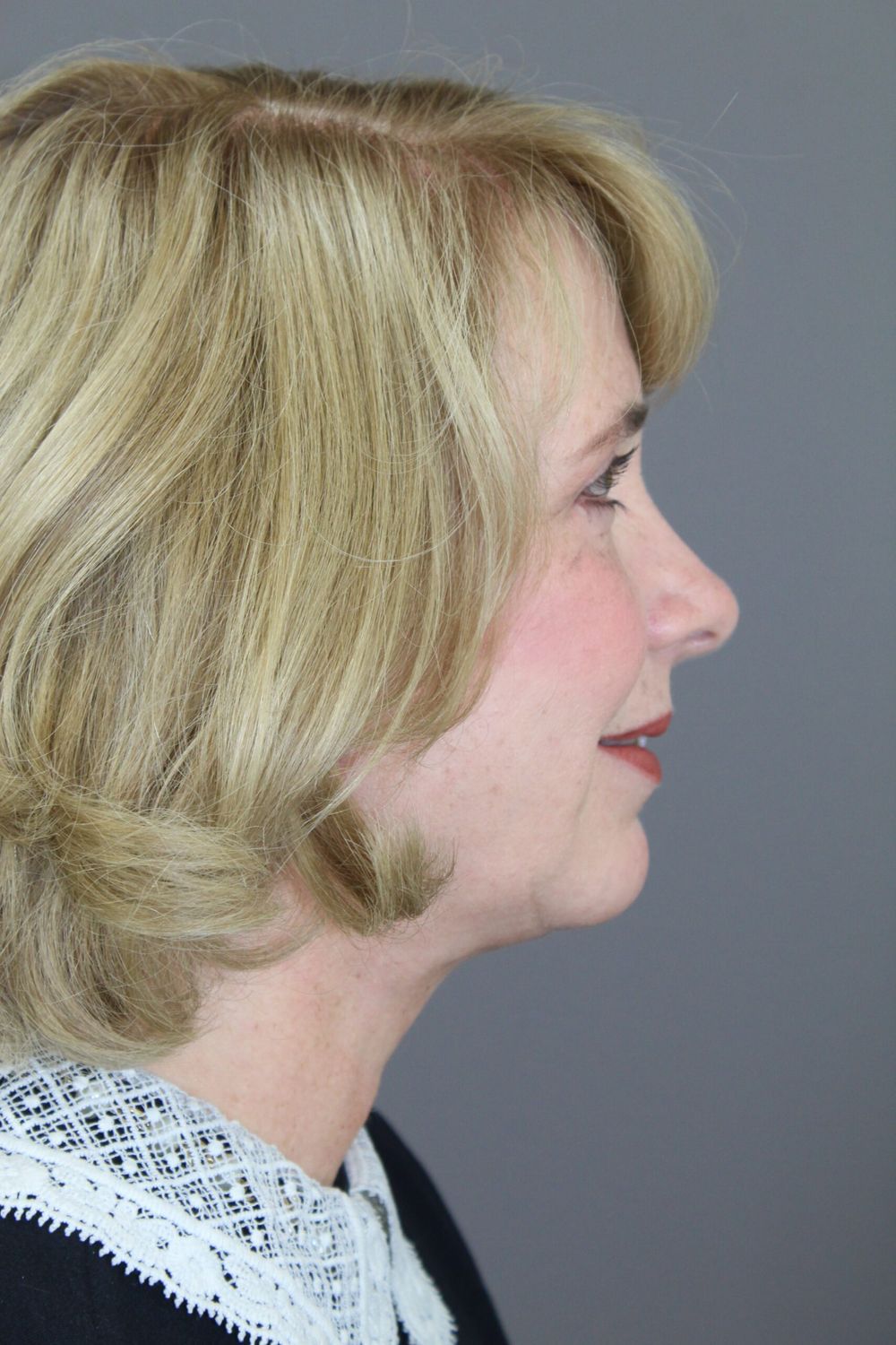 Zo Skin Health Before & After