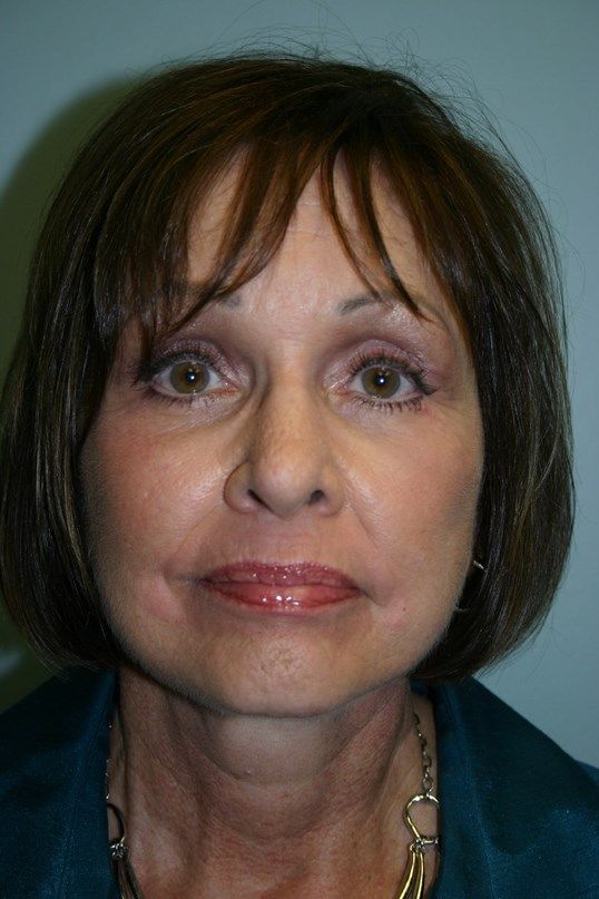 Zo Skin Health Before & After