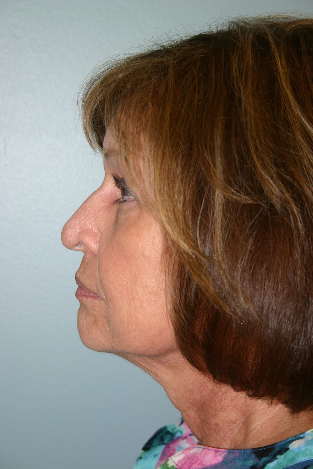 Zo Skin Health Before & After