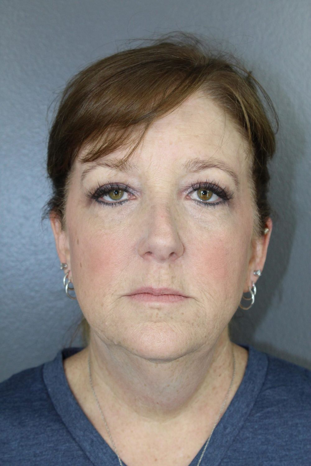 Zo Skin Health Before & After