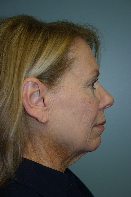 Zo Skin Health Before & After