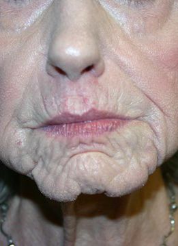 Zo Skin Health Before & After