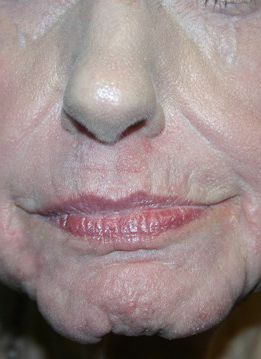 Zo Skin Health Before & After