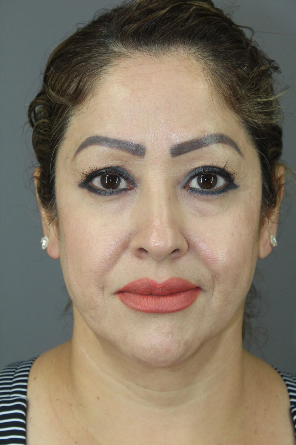 Neck Lift Before & After