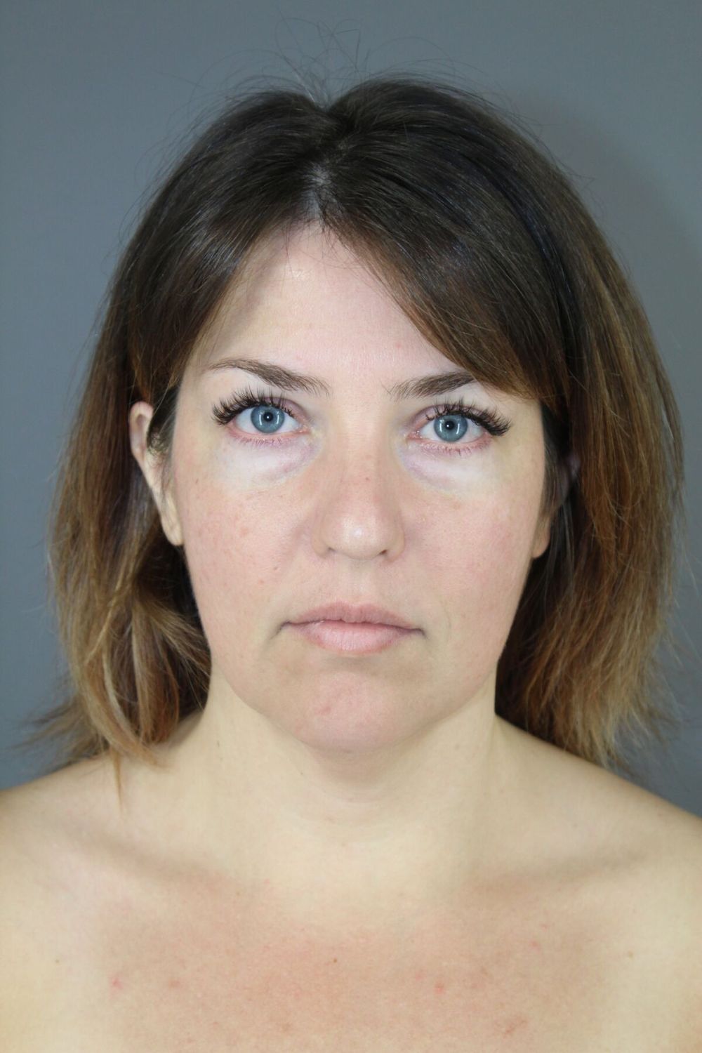 Neck Lift Before & After