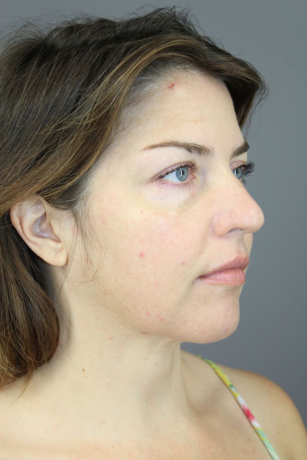 Neck Lift Before & After