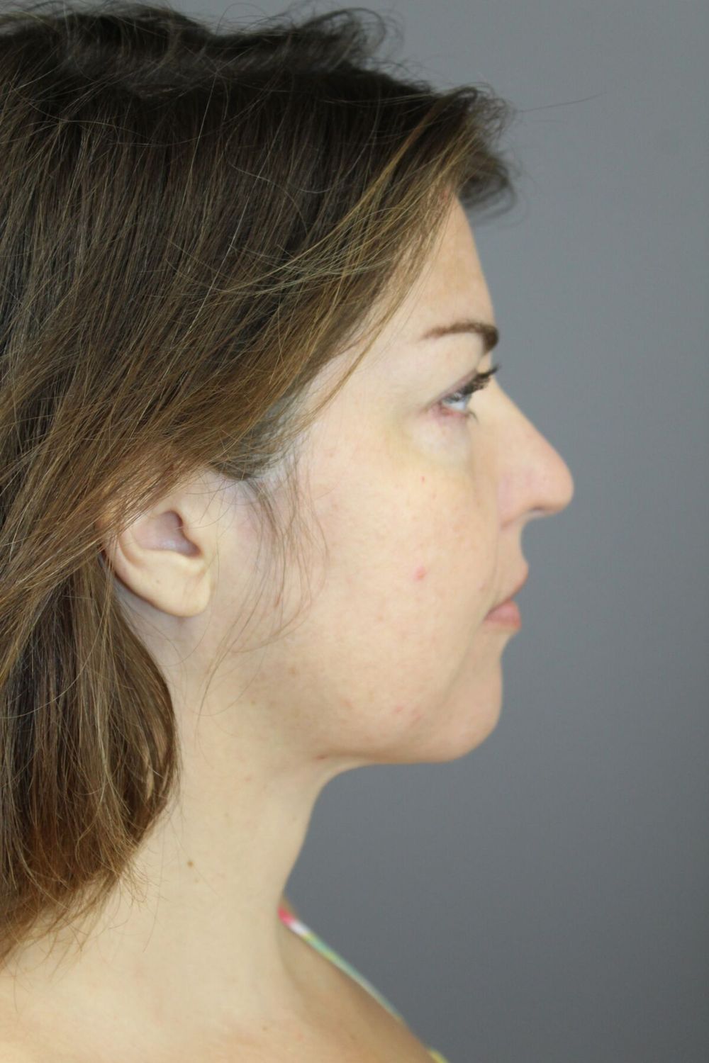 Neck Lift Before & After