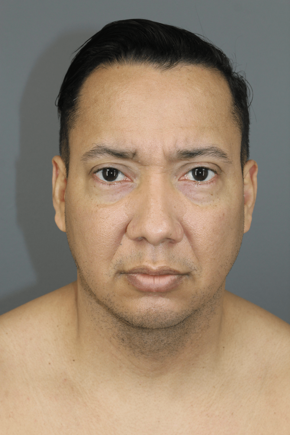 Neck Lift Before & After