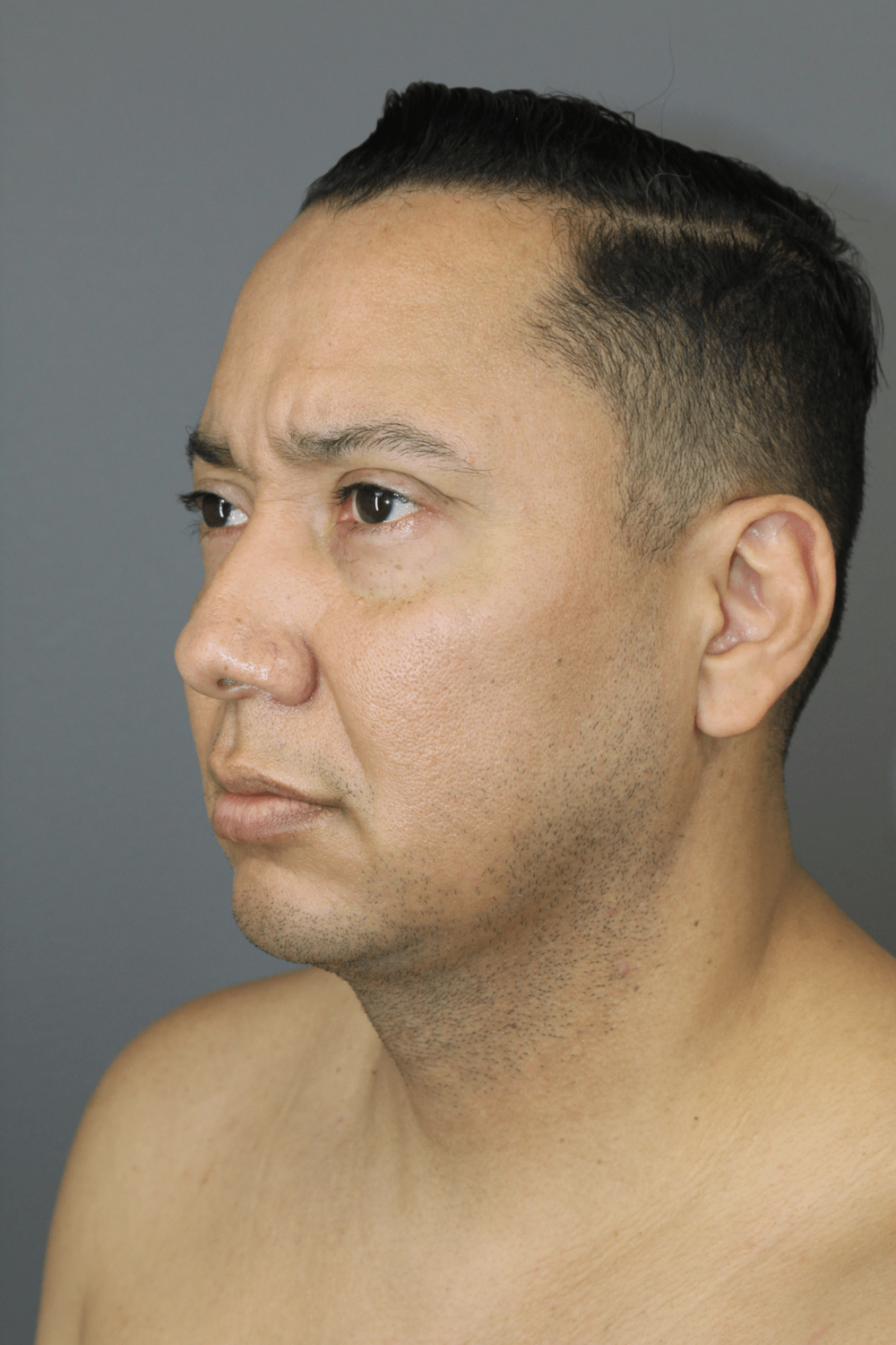 Neck Lift Before & After