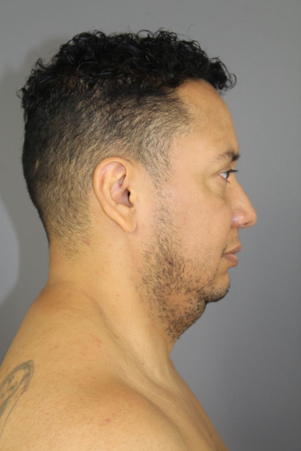 Neck Lift Before & After