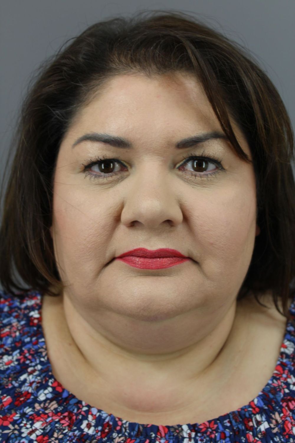 Neck Lift Before & After