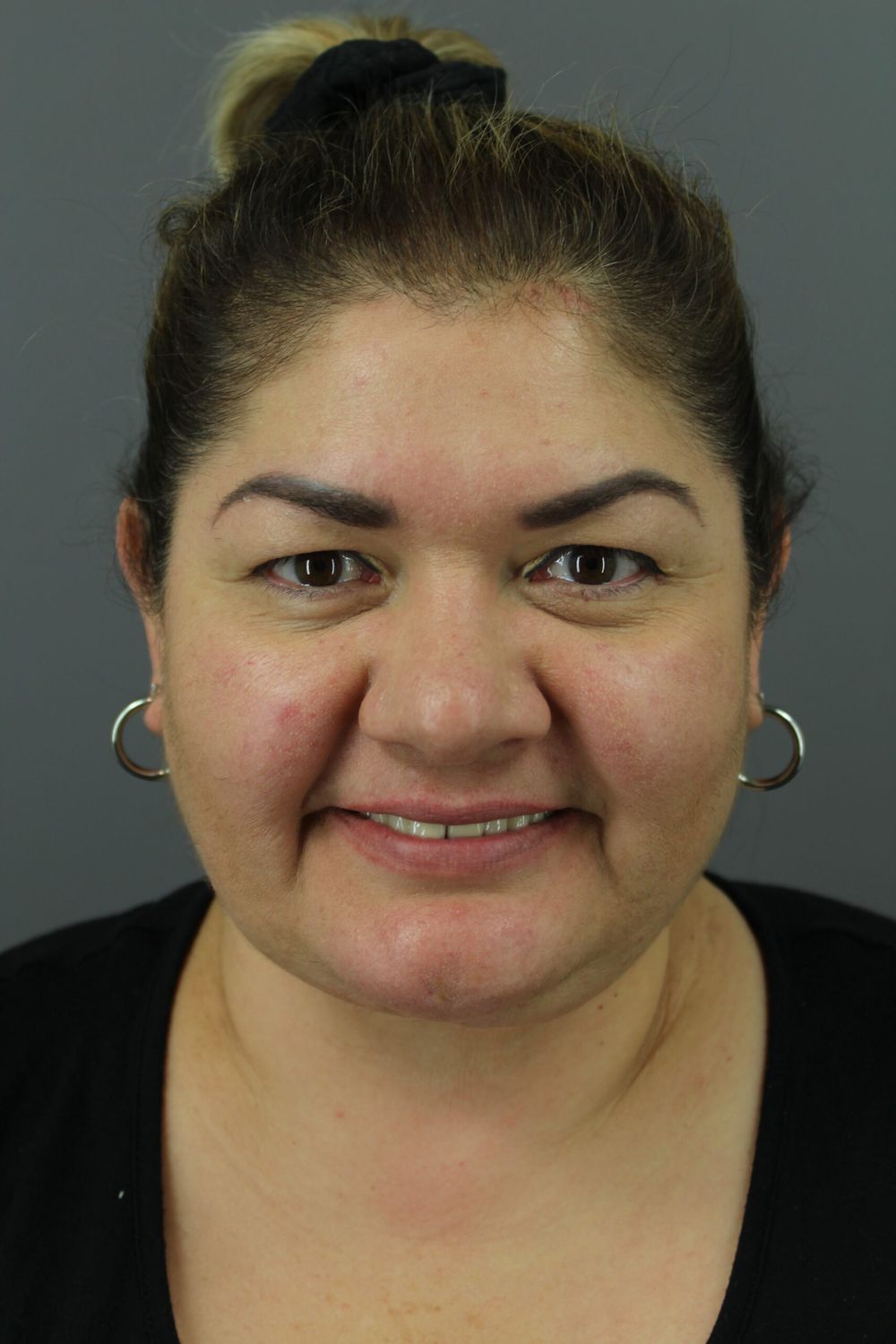 Neck Lift Before & After