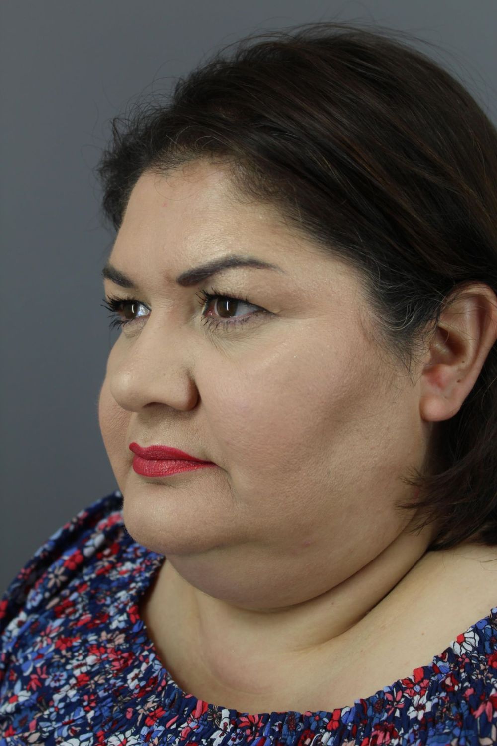 Neck Lift Before & After