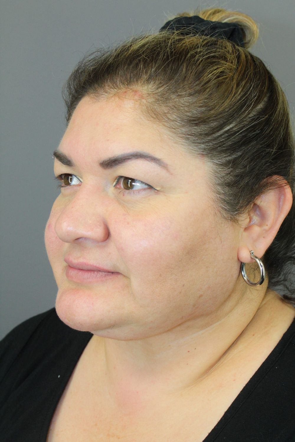 Neck Lift Before & After