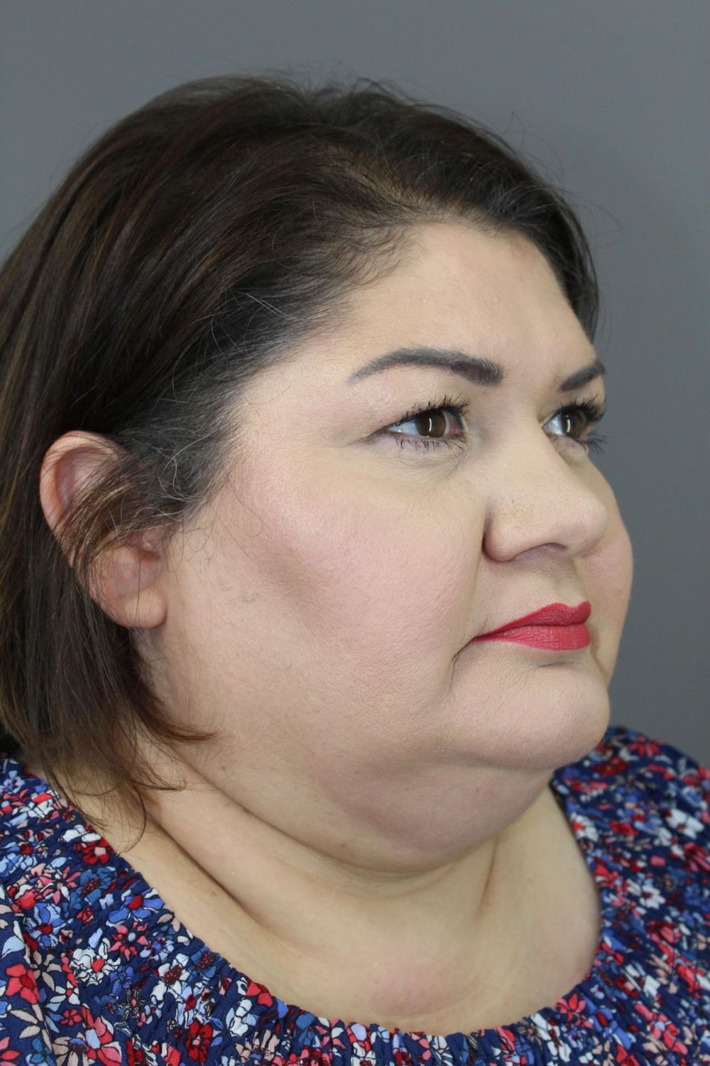 Neck Lift Before & After